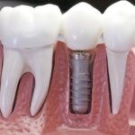 implant dentar în Bucureşti