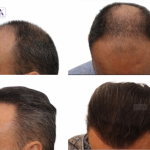 implant par pret dr felix hair implant