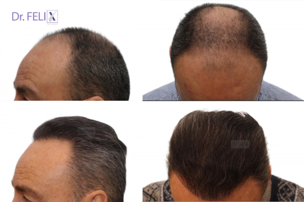 implant par pret dr felix hair implant